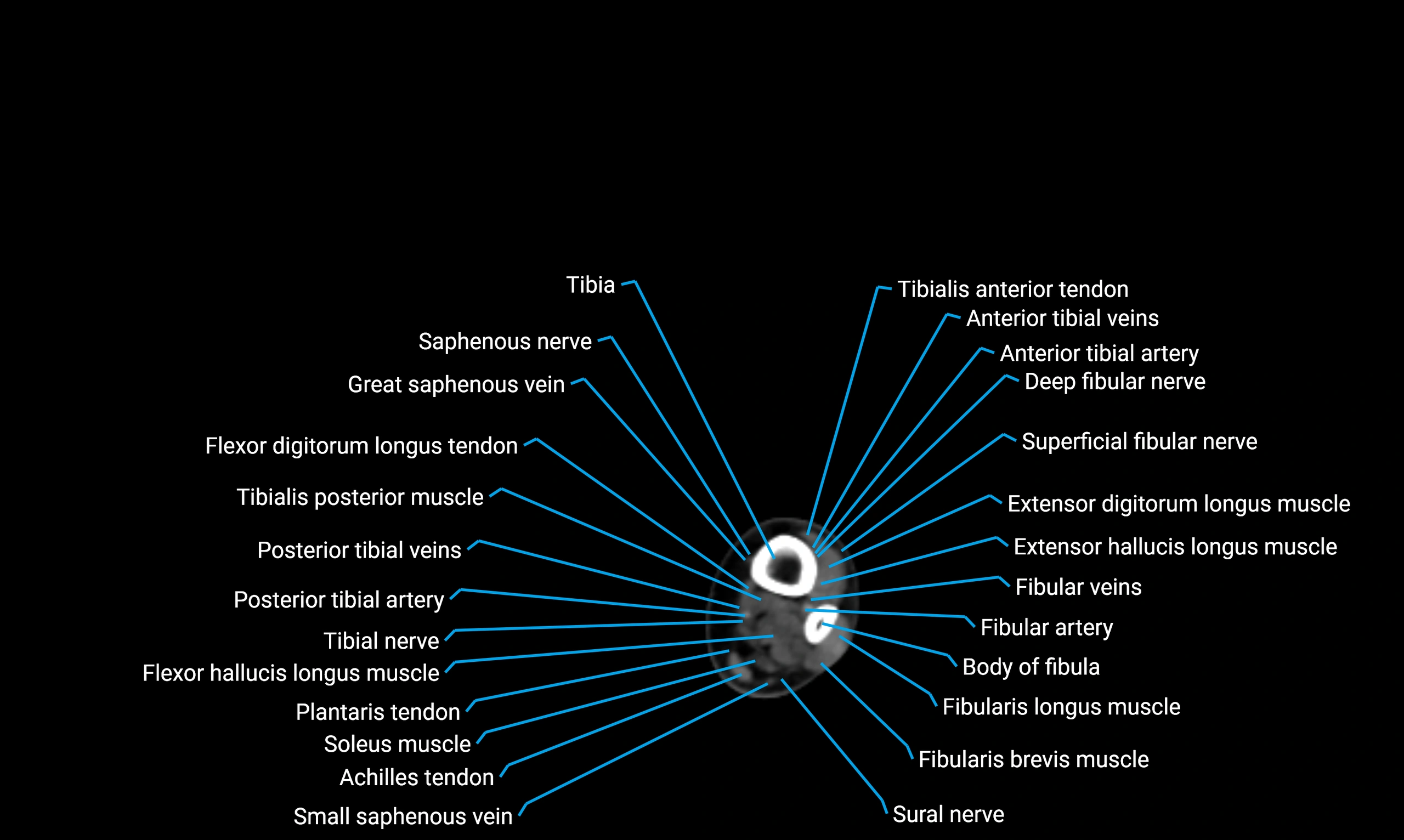 CT lower limb axial cross sectional anatomy labelled image 154 (2).webp